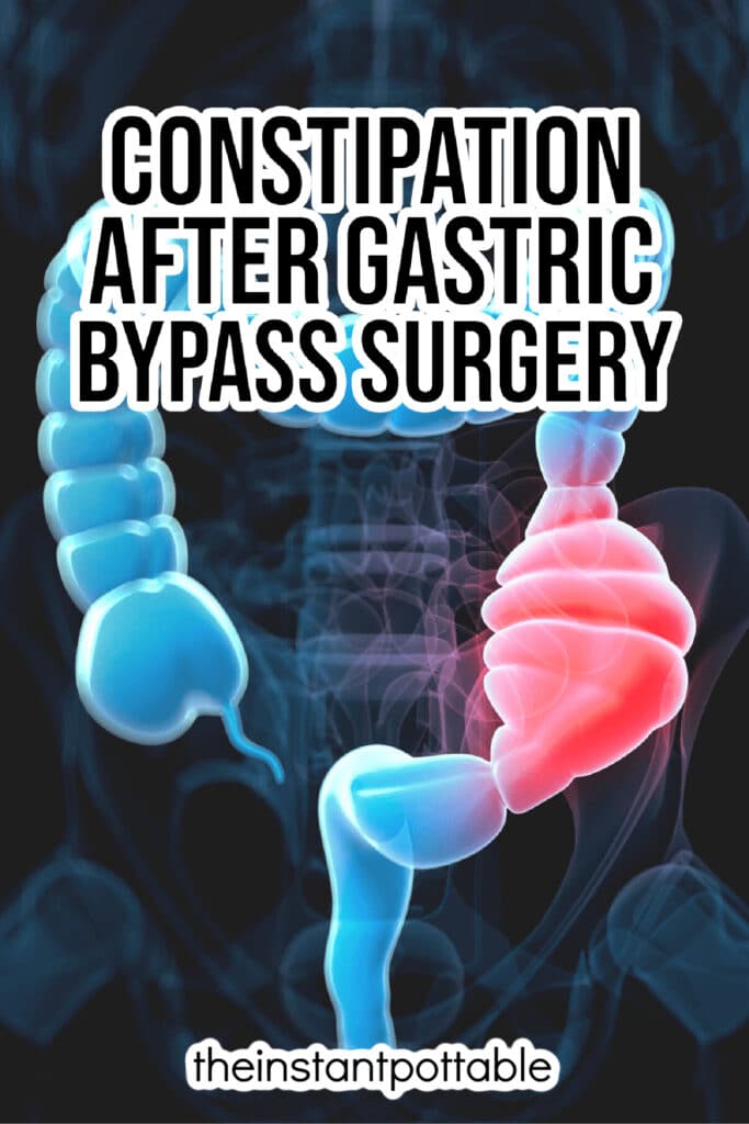 Constipation After Gastric Bypass Surgery 2 constipation